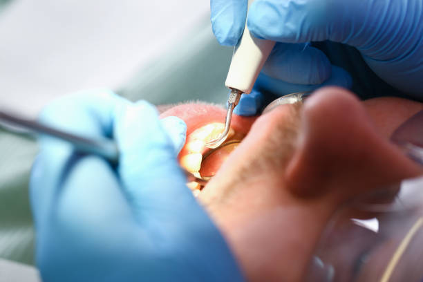 Best Emergency Wisdom Tooth Extraction in Fort Oglethorpe, GA