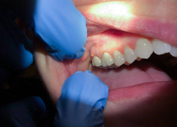 Best Emergency Care for Gum Disease in Fort Oglethorpe, GA